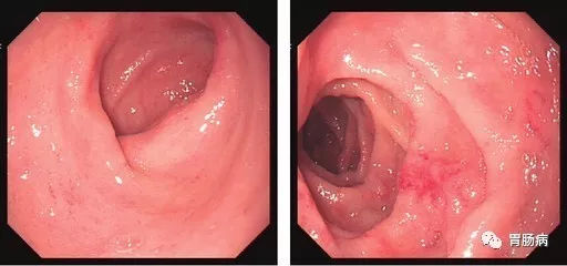 萎縮性胃炎不可怕，只要真正了解它