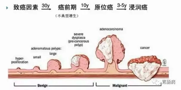 體檢查出腸息肉一定要切除！ 95%腸癌由它演變而來