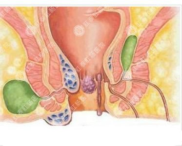南寧哪個(gè)醫(yī)院可以做肛周膿腫？